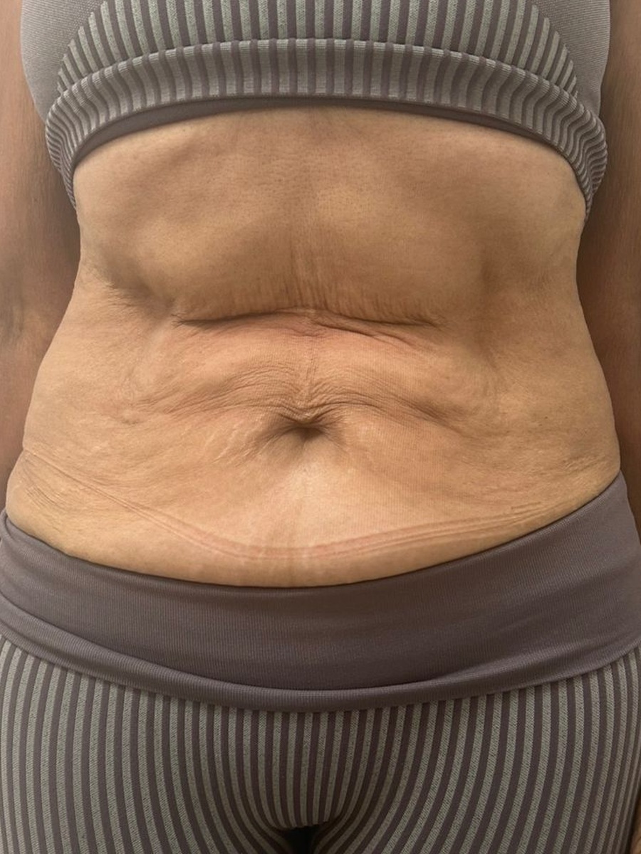 Região abdominal antes do protocolo