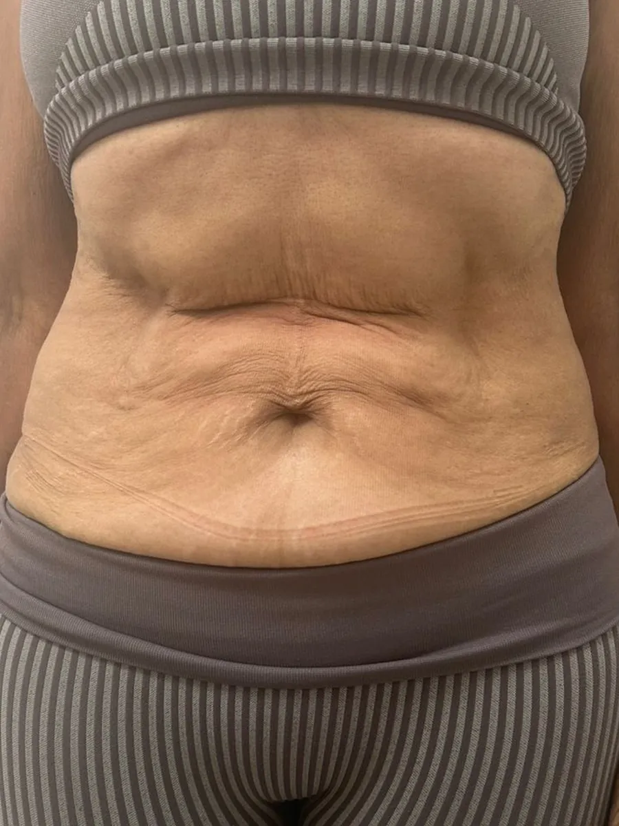 Região abdominal antes do protocolo