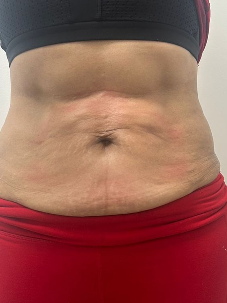 Região abdominal após o protocolo